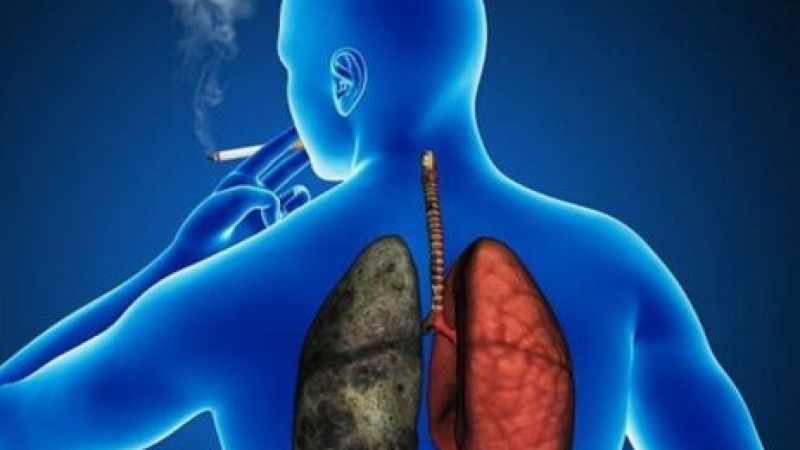KOAH hastalarında 10 yıl içinde akciğer kanseri gelişme ihtimali yüksek